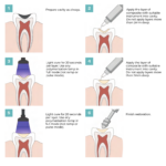 iflow workflow I cavities