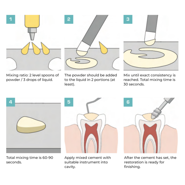 izoe eugenol cement workflow