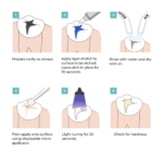 iseal fissure sealant workflow